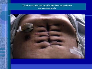 Técnica cerrada con incisión mediana en pacientes
con necrosectomia
 