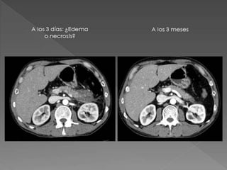 Pancreatitis Aguda Revision Atlanta 2012 Radiología