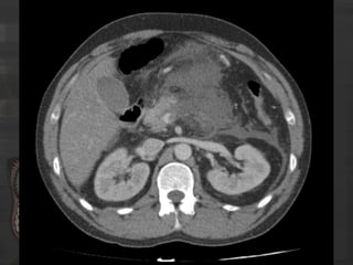 Pancreatitis Aguda Revision Atlanta 2012 Radiología