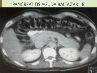 PANCREATITIS AGUDA BALTAZAR B
 