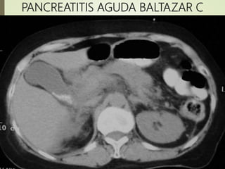 PANCREATITIS AGUDA BALTAZAR C
 