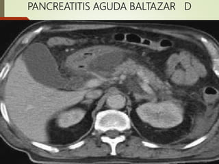 PANCREATITIS AGUDA BALTAZAR D
 