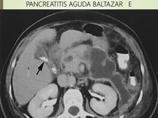 PANCREATITIS AGUDA BALTAZAR E
 