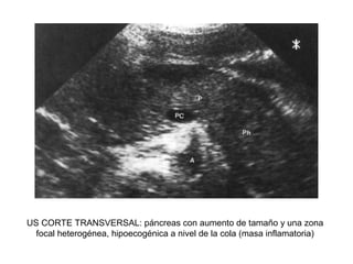 US CORTE TRANSVERSAL: páncreas con aumento de tamaño y una zona
focal heterogénea, hipoecogénica a nivel de la cola (masa inflamatoria)
 