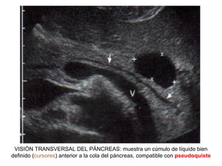 VISIÓN TRANSVERSAL DEL PÁNCREAS: muestra un cúmulo de líquido bien
definido (cursores) anterior a la cola del páncreas, compatible con pseudoquiste
 