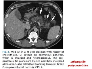 Inflamación
peripancreática
 