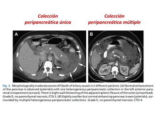 Colección
peripancreática única
Colección
peripancreática múltiple
 