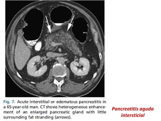 Pancreatitis aguda
intersticial
 