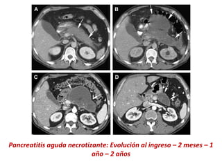 Pancreatitis aguda necrotizante: Evolución al ingreso – 2 meses – 1
año – 2 años
 