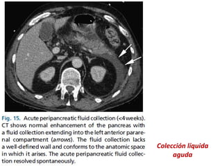 Colección líquida
aguda
 
