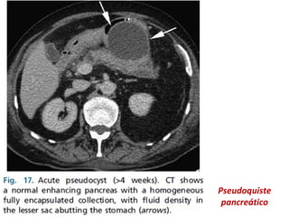 Pseudoquiste
pancreático
 