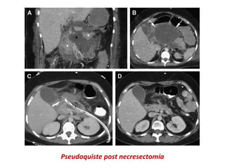 Pseudoquiste post necresectomía
 
