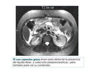 T2 con supresion grasaT2 con supresion grasa sirven para detectar la presenciasirven para detectar la presencia
de liquido libres y colección peripancreaticas , perode liquido libres y colección peripancreaticas , pero
tambien para ver su contenido .tambien para ver su contenido .
 