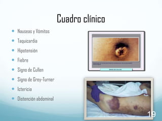 Cuadro clínico
 Nauseas y Vómitos
 Taquicardia
 Hipotensión
 Fiebre

 Signo de Cullen
 Signo de Grey-Turner
 Ictericia

 Distención abdominal

19

 