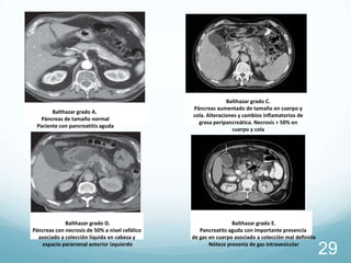 Balthazar grado A.
Páncreas de tamaño normal
Paciente con pancreatitis aguda

Balthazar grado D.
Páncreas con necrosis de 50% a nivel cefálico
asociado a colección líquida en cabeza y
espacio pararrenal anterior izquierdo

Balthazar grado C.
Páncreas aumentado de tamaño en cuerpo y
cola. Alteraciones y cambios inflamatorios de
grasa peripancreática. Necrosis > 50% en
cuerpo y cola

Balthazar grado E.
Pancreatits aguda con importante presencia
de gas en cuerpo asociado a colección mal definida
Nótece presenia de gas intravesicular

29

 