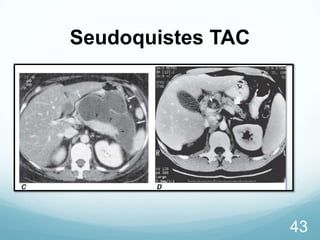 Seudoquistes TAC

43

 