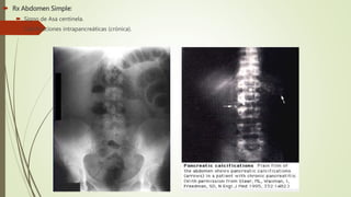  Rx Abdomen Simple:
 Signo de Asa centinela.
 Calcificaciones intrapancreáticas (crónica).
 