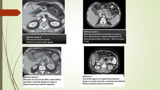 Balthazar grado A.
Páncreas de tamaño normal
Paciente con pancreatitis aguda
Balthazar grado C.
Páncreas aumentado de tamaño en cuerpo y
cola. Alteraciones y cambios inflamatorios de
grasa peripancreática. Necrosis > 50% en cuerpo
y cola
Balthazar grado D.
Páncreas con necrosis de 50% a nivel cefálico
asociado a colección líquida en cabeza y
espacio pararrenal anterior izquierdo
Balthazar E.
Pancreatits aguda con importante presencia
de gas en cuerpo asociado a colección mal definida
Nótece presenia de gas intravesicular
 
