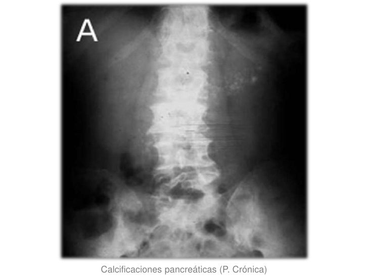 Pancreatitis aguda y cronica arturo zepeda Pancreatitis aguda y cronica arturo zepeda