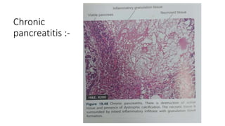 Chronic
pancreatitis :-
 