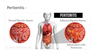Peritonitis -
 