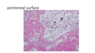 peritoneal surface
 