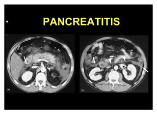 PANCREATITIS 
