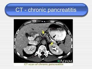 CT - chronic pancreatitis
 