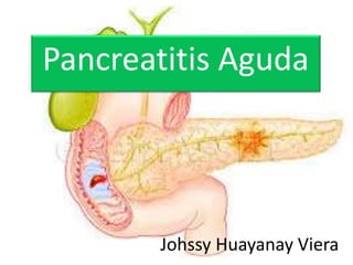 Johssy Huayanay Viera
Pancreatitis Aguda
 