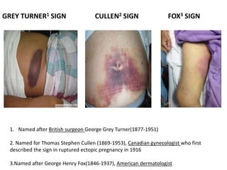 GREY TURNER1 SIGN CULLEN2 SIGN FOX3 SIGN
1. Named after British surgeon George Grey Turner(1877-1951)
2. Named for Thomas Stephen Cullen (1869-1953), Canadian gynecologist who first
described the sign in ruptured ectopic pregnancy in 1916
3.Named after George Henry Fox(1846-1937), American dermatologist
 