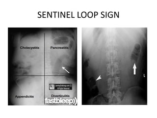SENTINEL LOOP SIGN
 