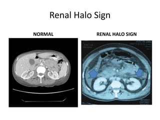 Renal Halo Sign
NORMAL RENAL HALO SIGN
 
