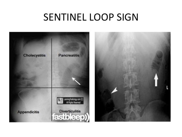 pancreatitis gastroenterology sentinel abdomen criteria diverticulitis erect αποθηκεύτηκε