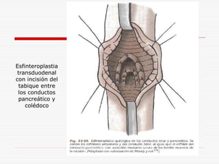 Esfinteroplastia
 transduodenal
con incisión del
  tabique entre
 los conductos
  pancreático y
    colédoco
 
