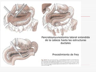 Pancratoyeyunestomia lateral extendida
   de la cabeza hasta las estructuras
                ductales



        Procedimiento de frey
 