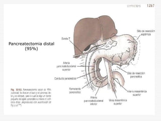 Pancreatectomia distal
       (95%)
 