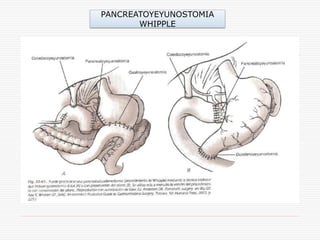 PANCREATOYEYUNOSTOMIA
       WHIPPLE
 