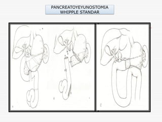 PANCREATOYEYUNOSTOMIA
   WHIPPLE STANDAR
 