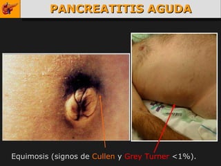 PANCREATITIS AGUDA Equimosis (signos de  Cullen  y  Grey Turner  <1%). 