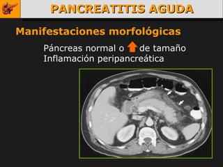 PANCREATITIS AGUDA Manifestaciones morfológicas Páncreas normal o  de tamaño Inflamación peripancreática 