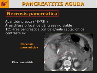 PANCREATITIS AGUDA Necrosis pancreática Aparición precoz (48-72h) Àrea difusa o focal de páncrees no viable TC: área pancreática con baja/nula captación de contraste ev. Páncreas viable Necrosis pancreàtica 