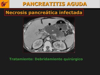 PANCREATITIS AGUDA Necrosis pancreática infectada Tratamiento: Debridamiento quirúrgico 