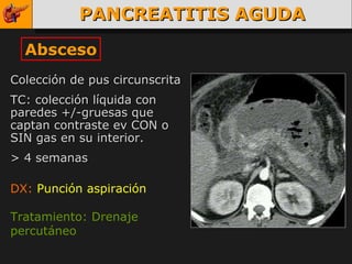 PANCREATITIS AGUDA Absceso Colección de pus circunscrita  TC: colección líquida con paredes +/-gruesas que captan contraste ev CON o SIN gas en su interior. > 4 semanas DX:   Punción aspiración   Tratamiento: Drenaje percutáneo 