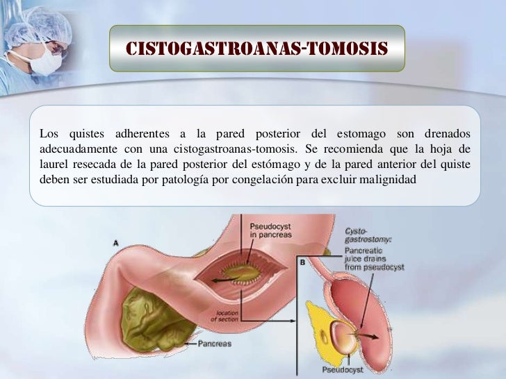 PSEUDOQUISTE PANCREATICO PDF PSEUDOQUISTE PANCREATICO PDF
