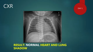 CXR
RESULT: NORMAL HEART AND LUNG
SHADOW
DAY 1
 