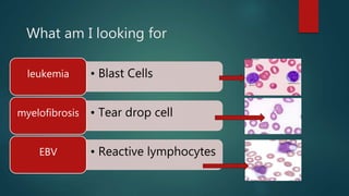What am I looking for
• Blast Cellsleukemia
• Tear drop cellmyelofibrosis
• Reactive lymphocytesEBV
 