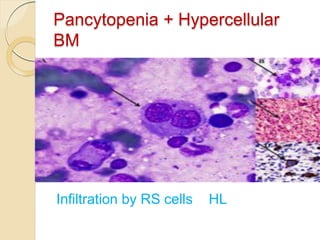 Pancytopenia + Hypercellular
BM
Infiltration by RS cells HL
 