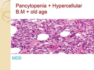 Pancytopenia + Hypercellular
B.M + old age
MDS
 
