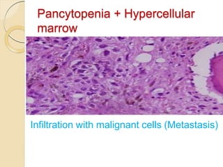 Pancytopenia + Hypercellular
marrow
Infiltration with malignant cells (Metastasis)
 