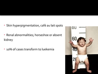 ▪ Skin hyperpigmentation, café au lait spots
▪ Renal abnormalities; horseshoe or absent
kidney
▪ 10% of cases transform to luekemia
 
